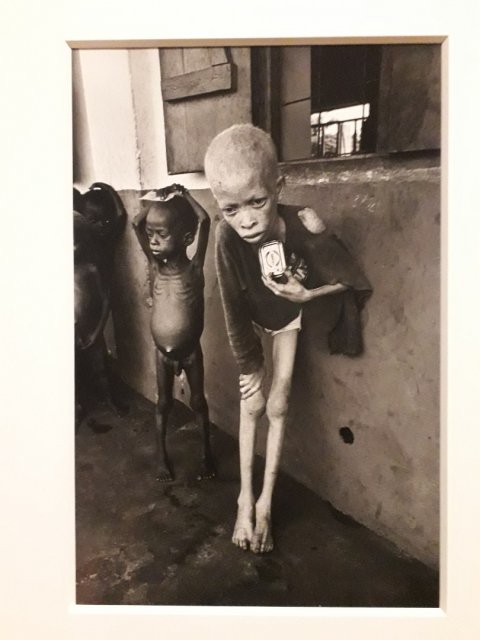 Biafra...albino boy